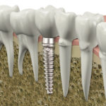 dental implants Manhattan