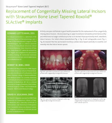 Replacement Of Congenitally Missing Lateral Incisors With