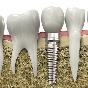 Dental implant