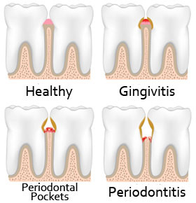 Stages of Periodontal Disease