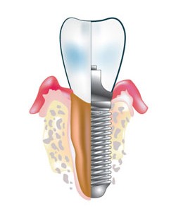 Tooth Implant Diagram