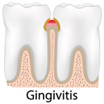 gum-disease-Manhattan