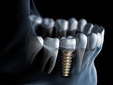 Dental Implants New York City