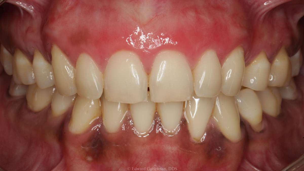 after gum bleaching