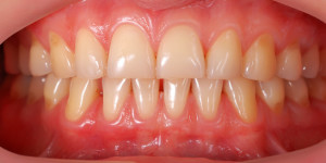 gum disease treatment Manhattan