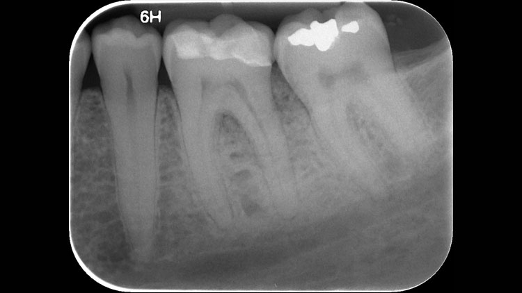 post op pocket reduction