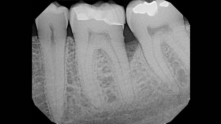 pre op pocket reduction