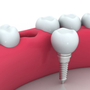 dental implants Manhattan