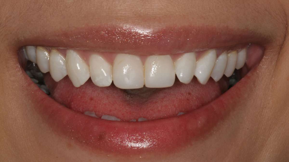 Lip Repositioning in Manhattan, NY | Enhance Your Smile