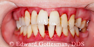 Human mouth after dental treatment - clean of tartar.
