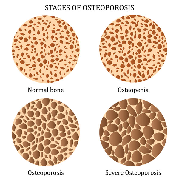 osteoporosis stages infograph