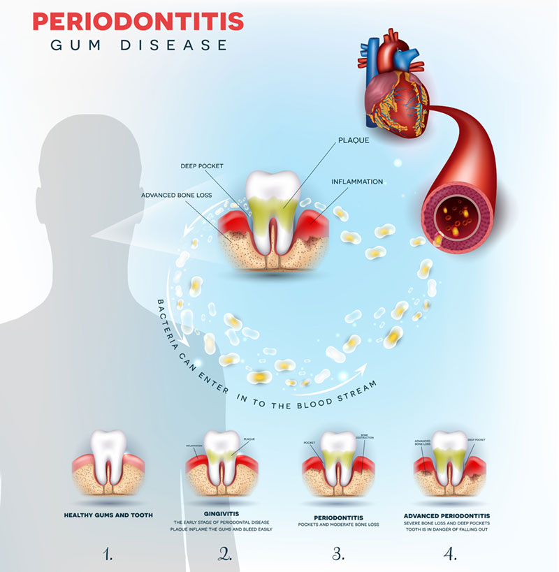 gum disease and heart disease